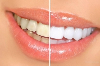 Отбеливатель зубов Dent 3D White light